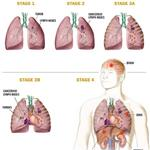  Hoá xạ trị đồng thời trong điều trị ung thư phổi tại Bệnh Viện Đa Khoa Hải Dương.